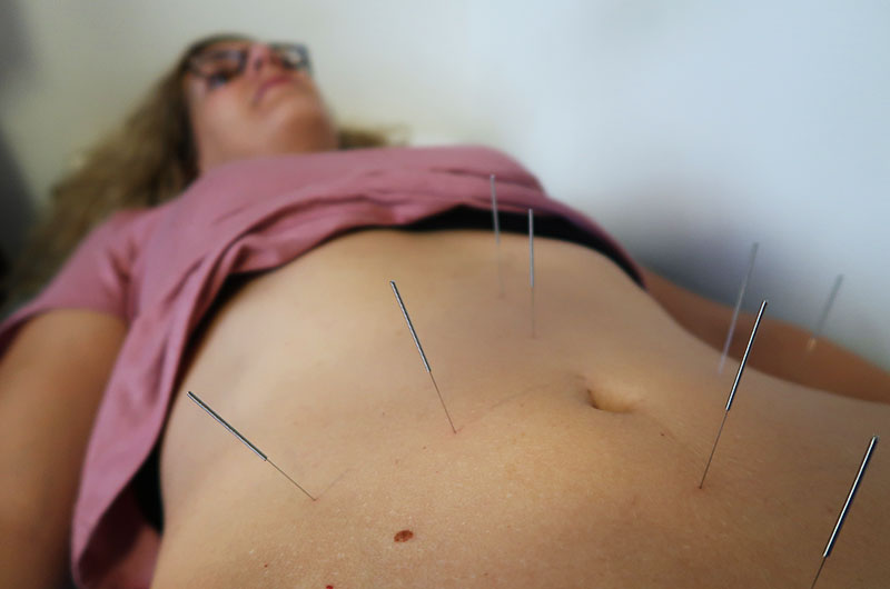 chinese acupunctuur